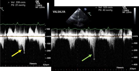 midcavitary gradient on echocardiogram